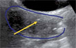 Pictorial essay: Advantages of real-time transabdominal ultrasound guidance in combined interstitial/intracavitary cervical brachytherapy: a case-based review